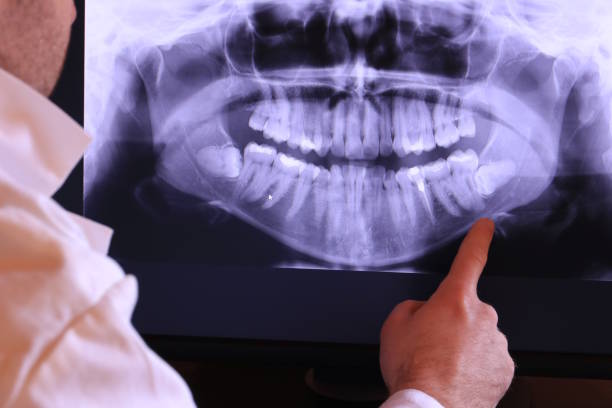 Best Emergency Wisdom Teeth Removal in Atkinson, NE